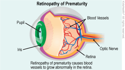 Retinopathy of prematurity