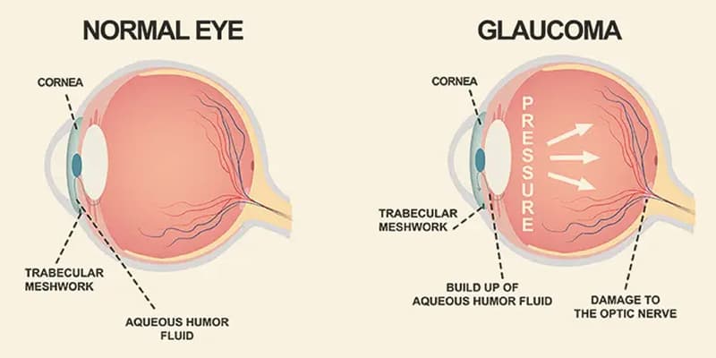 Glaucoma